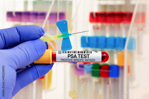 doctor with Blood tube and catheter for PSA Prostate specific antigen test in biochemistry lab. Blood sample of patient for PSA Free and PSA Total tests in laboratory photo