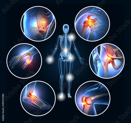 Painful joints, rheumatoid arthritis, osteoarthritis, 3D illustration