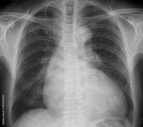 chest x-ray image of cardiomegaly 
