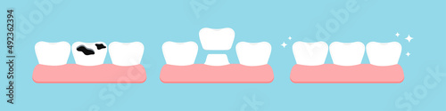 Teeth multiple caries, crown stage in gym before and after dental icon set isolated. Teeth dentistry restoration with ceramic crown in cavity treatment concept. Flat cartoon vector illustration.