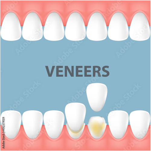 Teeth and smile makeover with dental ceramic veneers, row of foretooth before and after veneer cover, vector