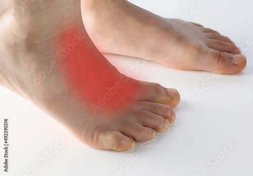 Close up human foot with red area to point of pain on top of foot on extensor tendonitis caused by tight shoe, flat feet, prolong standing , muscle tightness in children isolated on white background. photo