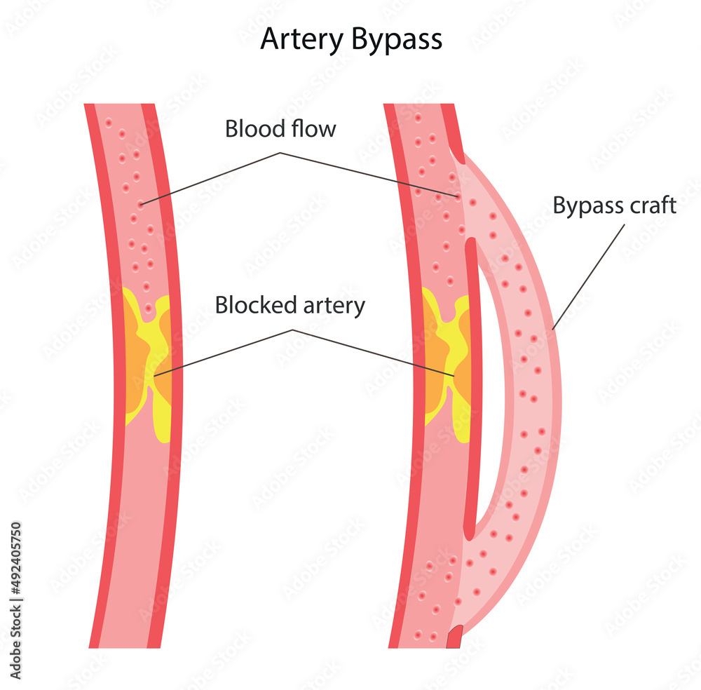 coronary artery bypass surgery, and colloquially heart bypass or bypass