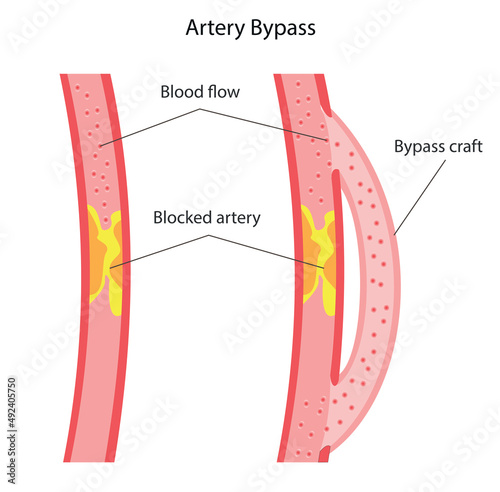 coronary artery bypass surgery, and colloquially heart bypass or bypass surgery photo