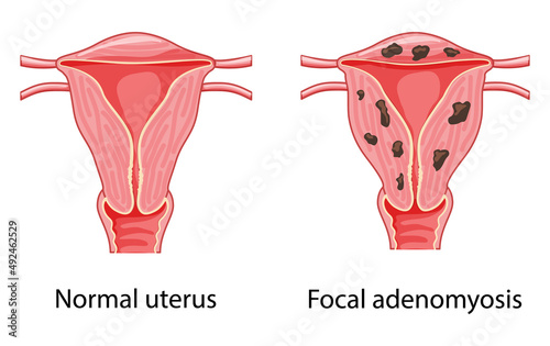 Adenomyosis Focal Human anatomy Female reproductive Normal and Sick system organs. Location scheme uterus vagina icon. Vector medical Cross section illustration isolated on white background