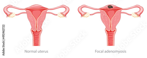 Focal Adenomyosis Human anatomy Female Sick and normal reproductive system organs. Location scheme Cross section uterus, cervix, ovary, fallopian tube icon. Vector illustration isolated on white