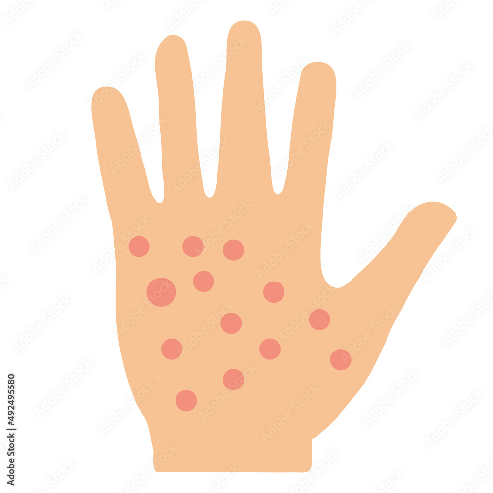 eczema hand skin icon on white background. allergic reaction symbol. irritation on hand sign. flat style. eczema hand skin icon on white background. allergic reaction symbol. irritation on hand sign. flat style.
