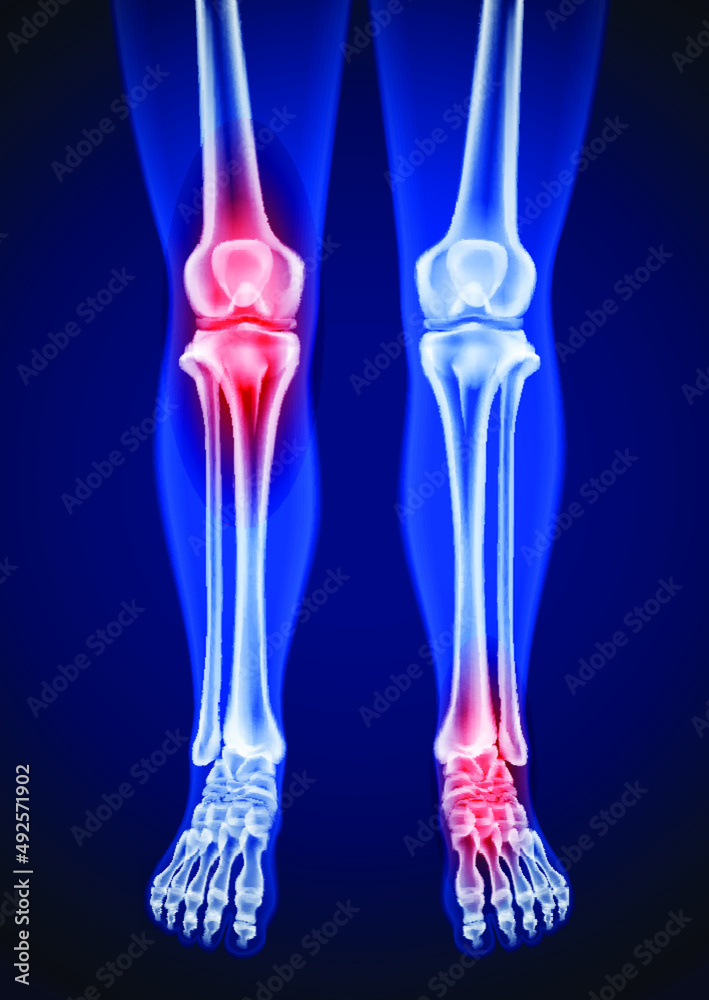 Human femur, knee and foot x-rays showing pain points in red for medical and educational use on a blue background. Human femur, knee and foot x-rays showing pain points in red for medical and educational use on a blue background.