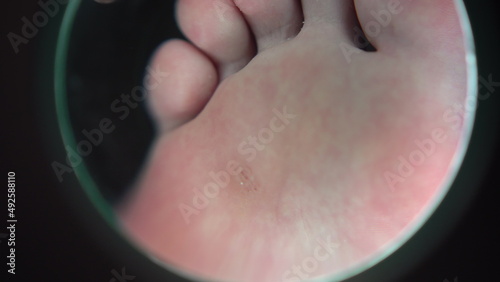 A magnifying glass zooms in on a wart on a girl's leg in a podiatrist's salon. View of the leg through a large magnifying glass.