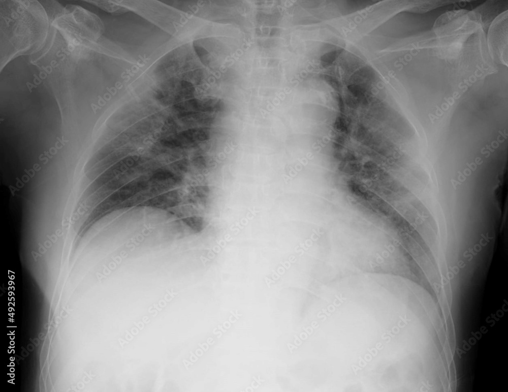 chest x-ray image of covid 19 pneumonia patient show consolidation ...