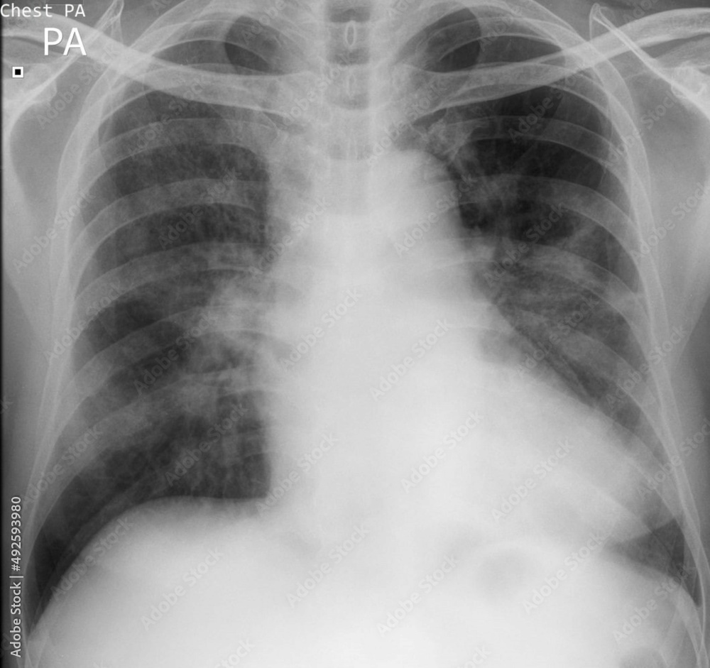 chest xray image of covid 19 pneumonia patient show consolidation