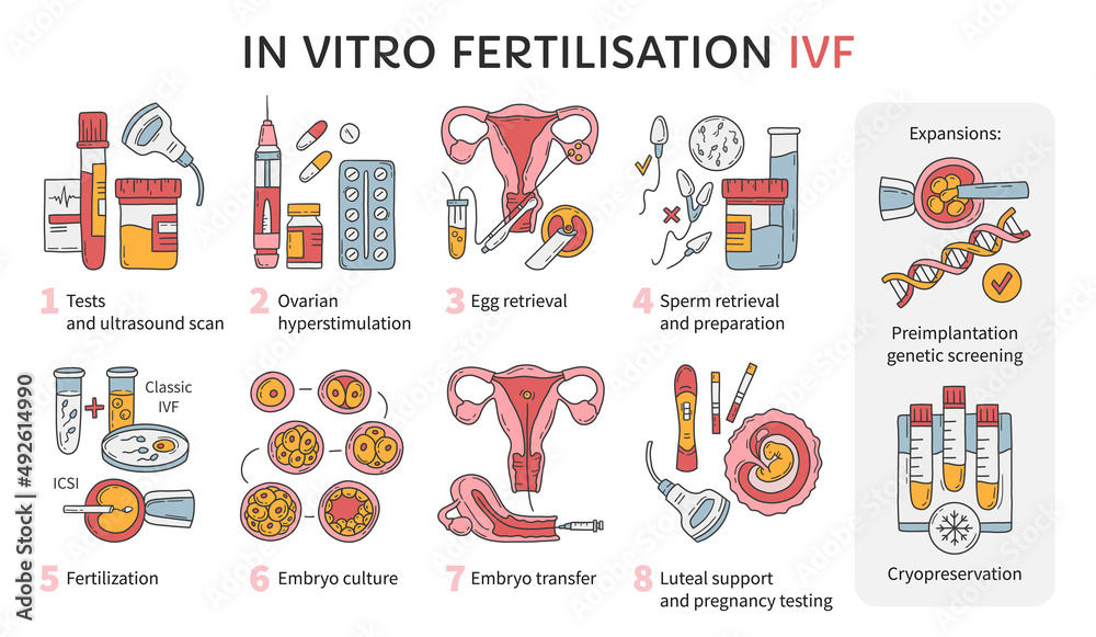 In Vitro fertilization IVF vector infographic and infertility treatment