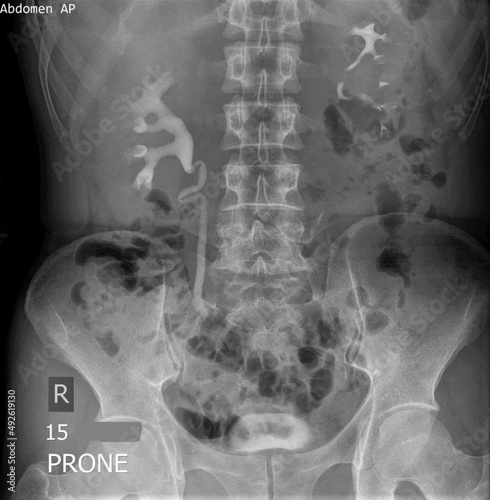 x-ray image of intravenous pyelography photo