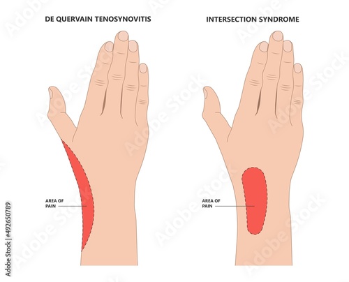 De quervain's pain tendon thumb wrist hurt grasp make a fist sport muscle hand Finkelstein's test bend brace finger strain trigger carpal tunnel brevis Eichhoff's stretch radial Grip spring relief