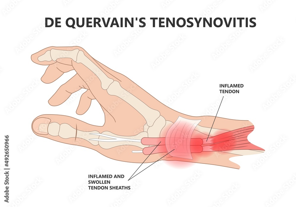 De quervain's pain tendon thumb wrist hurt grasp make a fist sport