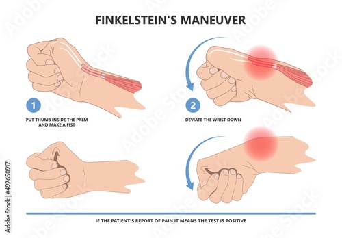 Fotobehang De quervain's pain tendon thumb wrist hurt grasp make a fist sport muscle hand F
