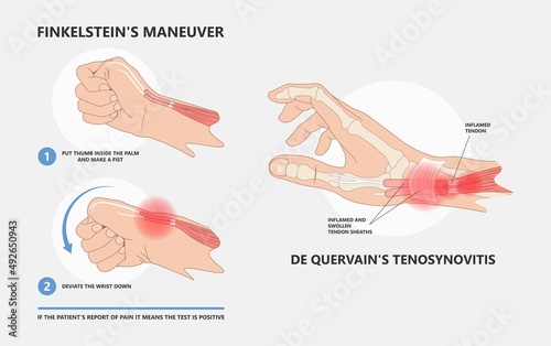 Foto De quervain's pain tendon thumb wrist hurt grasp make a fist sport muscle hand F
