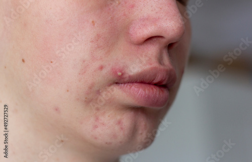 A picture of acne on the face of a teenager . Pimples, red scars and black dots on cheeks and chin. The concept of problem skin, care and beauty.