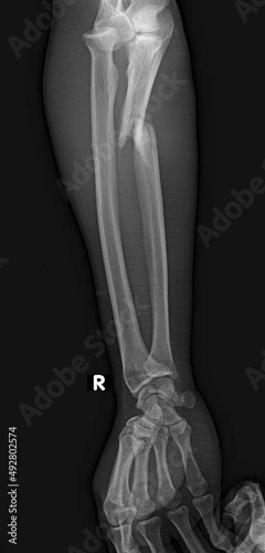 monteggia fracture, proximal ulna fracture with radial head dislocation, x ray   © therads