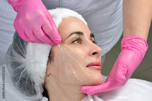 Thread lifting. Tightening of flabby skin in the jaw area with the help of cosmetic threads. Thread lifting. Tightening of flabby skin in the jaw area with the help of cosmetic threads.