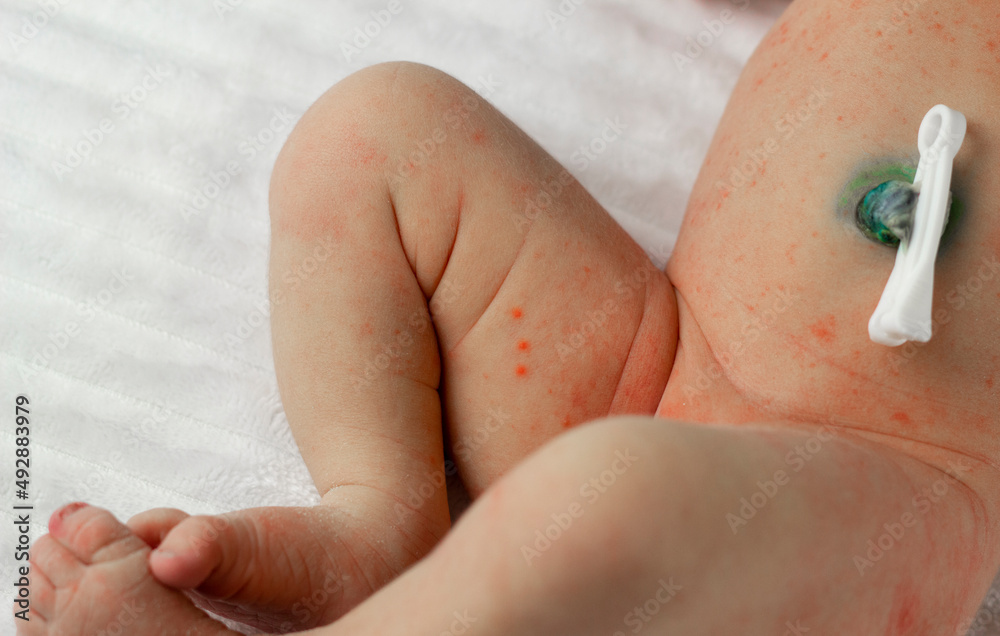 diaper rash in babies and care for them from the first days of birth diaper rash in babies and care for them from the first days of birth