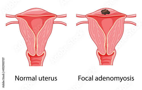 Focal Adenomyosis Human anatomy Female reproductive system diagram with text Sick and normal organ uterus vagina Cross section icon. Vector carton flat illustration isolated on white background