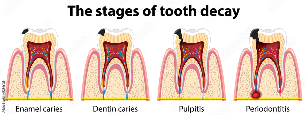 Infographic of human in the stages of tooth decay Stock Vector | Adobe ...