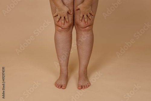 Cropped photo of woman bare naked legs, pinching fat on knees. Clipping fat folds. Removal of fat knees, liposuction of edematous skin. Varicose vein, dehydrated thick skin. Body care. Fat loss photo