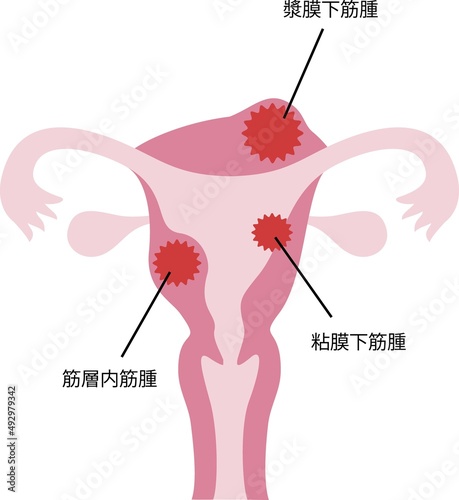 子宮筋腫のイラスト