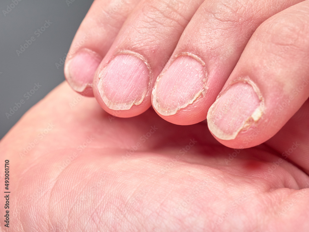 Hand Of A 9 Year Old Boy Showing His Fingernails With Brittle Or Very 