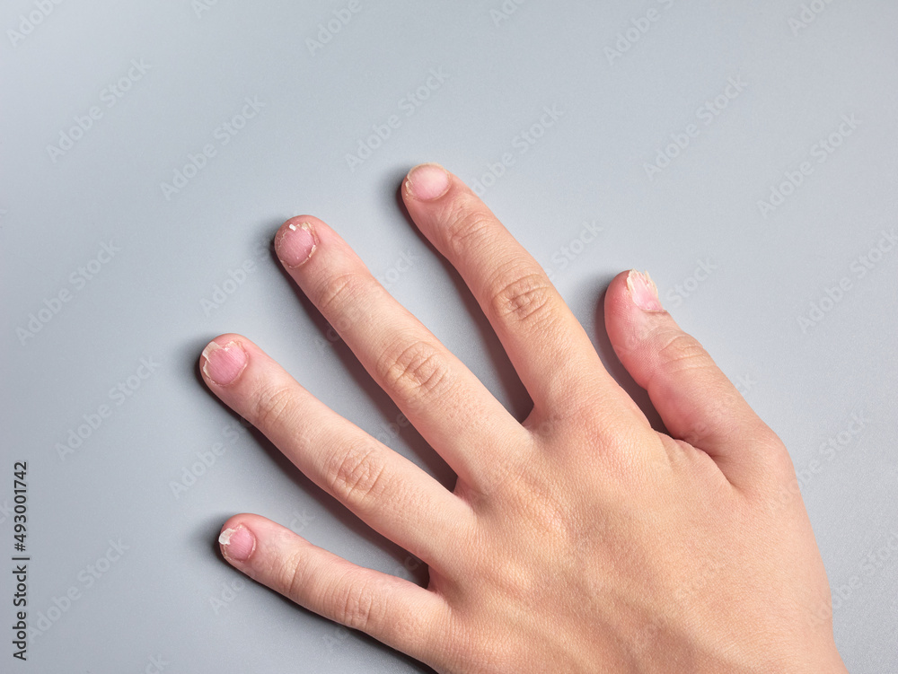 Hand of a 9 year old boy with brittle nails isolated on gray background, nails disease - obrazy, fototapety, plakaty 