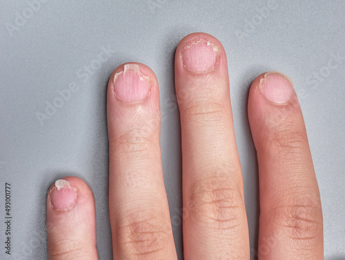 Photos Hand of a young boy with brittle or very weak nails, isolated on gray background