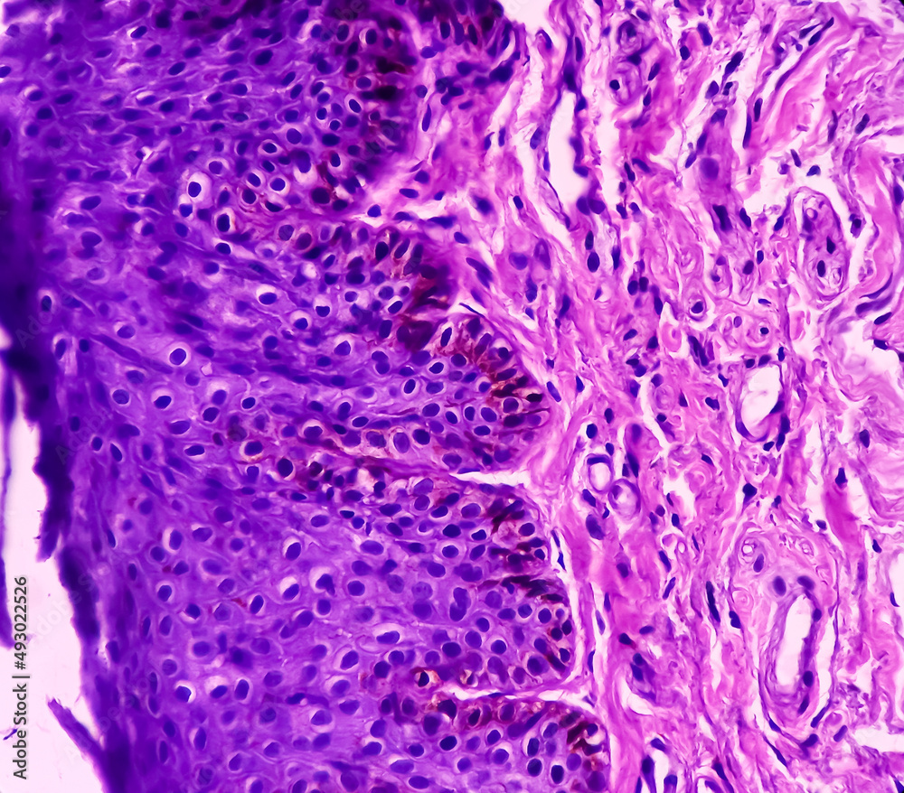 Prostate histology(TURP): Photomicrograph of biopsy of prostate gland ...