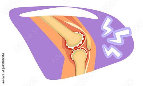 Knee pain 2D vector isolated illustration. Ruptured ligament risk flat sticker on cartoon background. Arthritis conditions. Overuse injury colourful scene for mobile, website, presentation