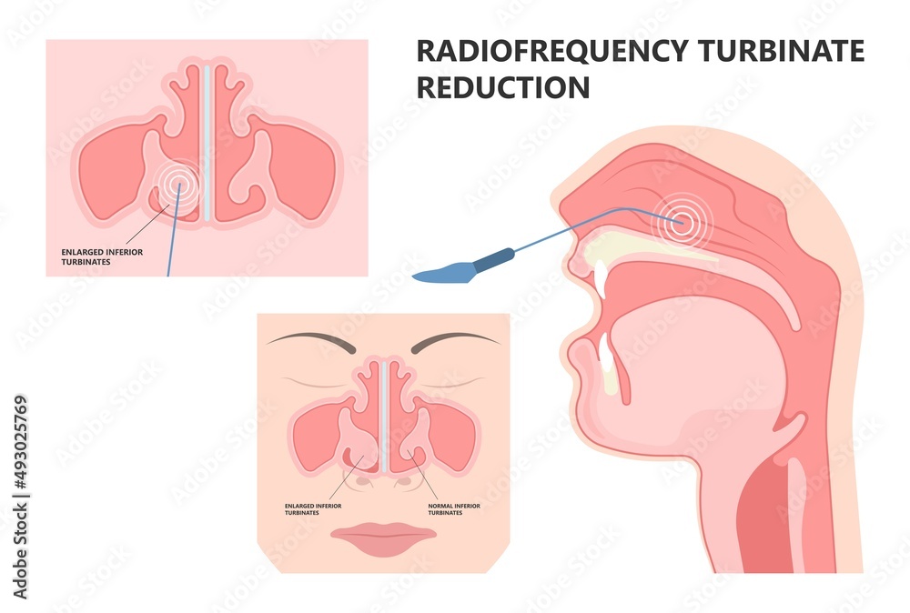 Deviated Ear ENT CPAP nose stop apnea block laser nasal RAVOR RFVTR ...