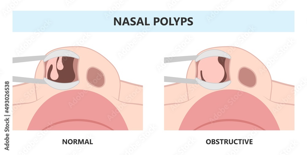 Deviated Ear ENT CPAP nose stop apnea block laser nasal RAVOR RFVTR