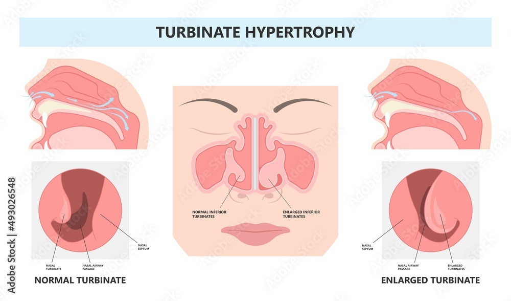 Deviated Ear ENT CPAP nose stop apnea block laser nasal RAVOR RFVTR ...