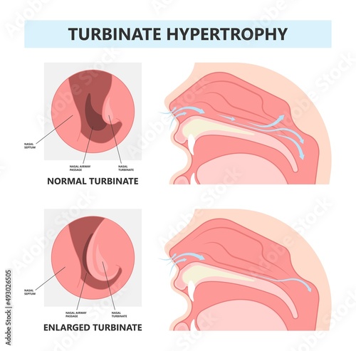 Deviated Ear ENT CPAP nose stop apnea block laser nasal RAVOR RFVTR runny sinus sleep treat airway concha device mucous polyps septal septum throat tissue airflow air way bullosa drip allergic