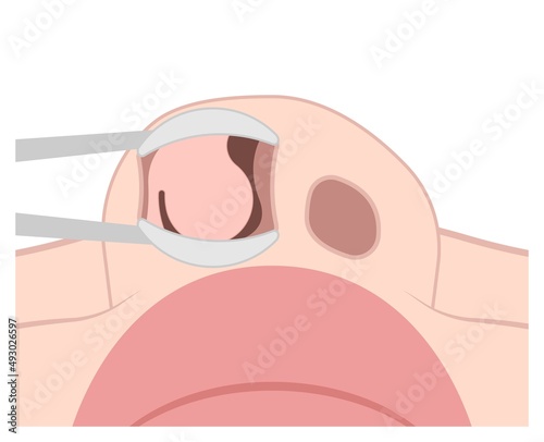 Deviated Ear ENT CPAP nose stop apnea block laser nasal RAVOR RFVTR runny sinus sleep treat airway concha device mucous polyps septal septum throat tissue airflow air way bullosa drip allergic