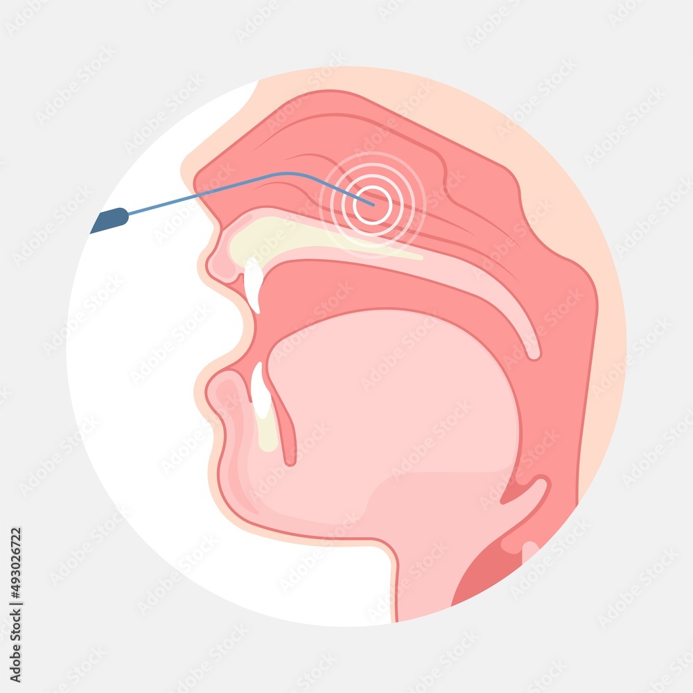 Deviated Ear ENT CPAP nose stop apnea block laser nasal RAVOR RFVTR runny sinus sleep treat airway concha device mucous polyps septal septum throat tissue airflow air way bullosa drip allergic Deviated Ear ENT CPAP nose stop apnea block laser nasal RAVOR RFVTR runny sinus sleep treat airway concha device mucous polyps septal septum throat tissue airflow air way bullosa drip allergic