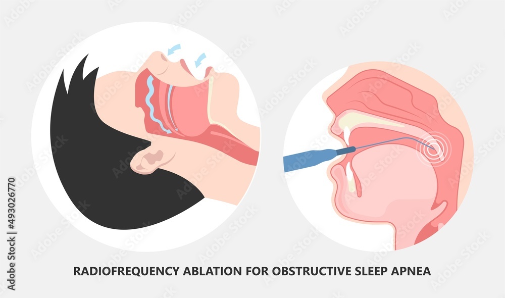 Deviated Ear ENT CPAP nose stop apnea block laser nasal RAVOR RFVTR runny sinus sleep treat