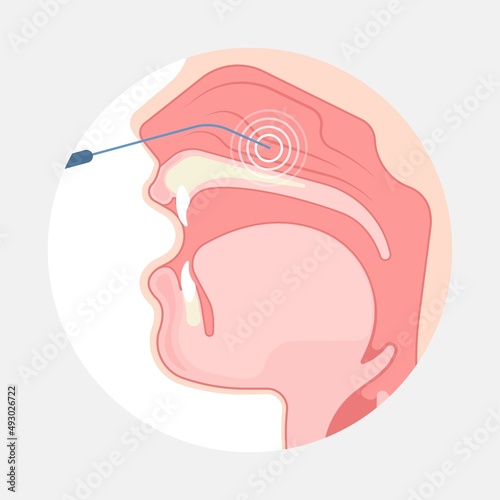 Deviated Ear ENT CPAP nose stop apnea block laser nasal RAVOR RFVTR runny sinus sleep treat airway concha device mucous polyps septal septum throat tissue airflow air way bullosa drip allergic