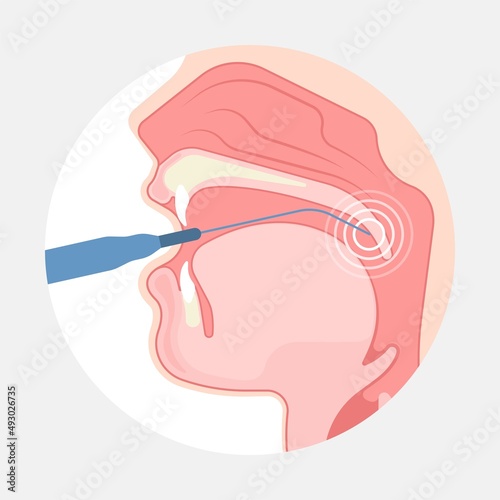 Deviated Ear ENT CPAP nose stop apnea block laser nasal RAVOR RFVTR runny sinus sleep treat airway concha device mucous polyps septal septum throat tissue airflow air way bullosa drip allergic