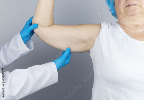 Brachioplasty. Plastic arms  dangling skin at the elbow. An older woman shows the surgeon problem areas of the forearm. Examination before cosmetic surgery