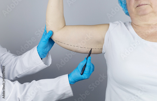 Brachioplasty. Plastic arms, dangling skin at the elbow. An older woman shows the surgeon problem areas of the forearm. Examination before cosmetic surgery