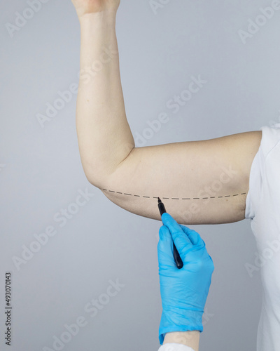 Brachioplasty. Plastic arms, dangling skin at the elbow. An older woman shows the surgeon problem areas of the forearm. Examination before cosmetic surgery photo