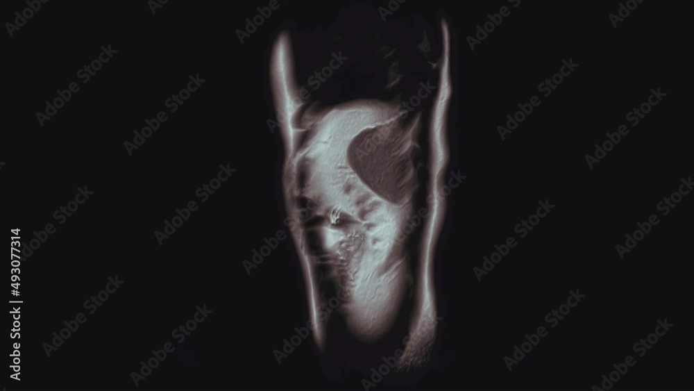 Voluminous color CT scan of the abdomen. Computed tomography of the gastrointestinal tract, liver and kidneys