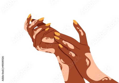 Hands with vitiligo disorder. Poster for supporting people living with vitiligo.