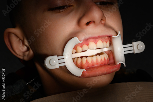 Plastic retractor for lip augmentation in the mouth, dental procedure and retractor as an auxiliary element. photo