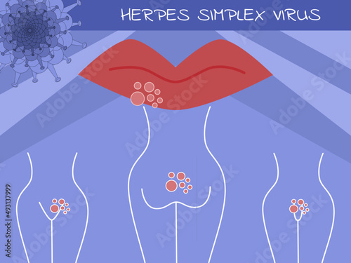 Herpes simplex virus (HSV) photo